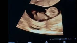 Fetus 11 weeks. Ultrasound shows movements, nasal bone, crown rump length- Dr. Kağan Kocatepe
