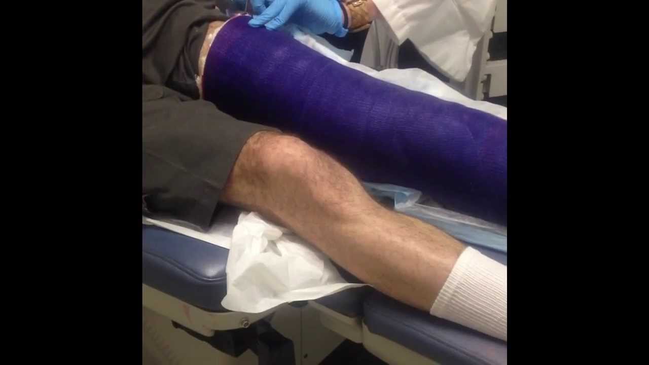 Video862 Full Leg Cast Removal Youtube