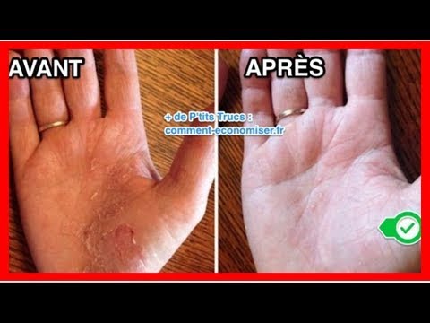 psoriasis remède de grand mère