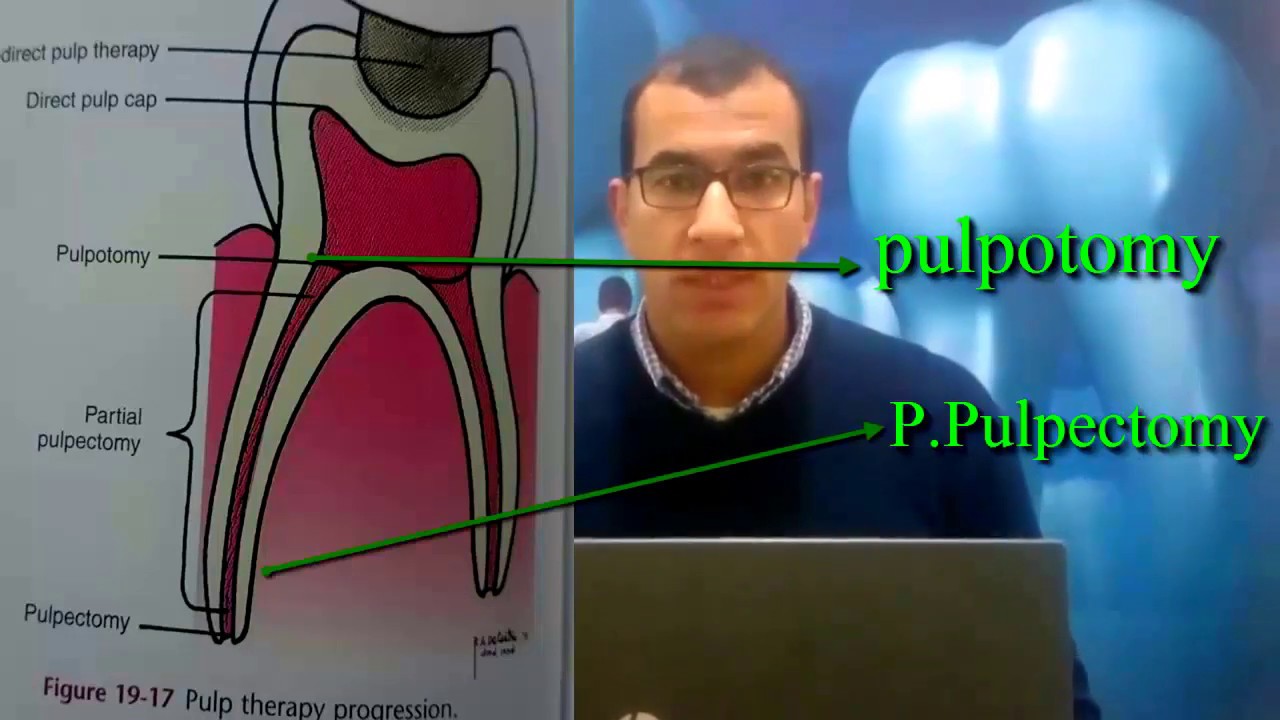 ال pulpotomy في 5 دقائق