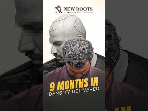 Diffuse Baldness Hair Transplant in Hyderabad | 9 Months Result #hairtransplant #hyderabad #shorts