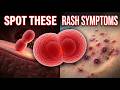 How To Spot Meningitis Before It's Too Late