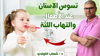 تسوس اسنان الاطفال والتهاب اللثة عند الاطفال - علاج تسوس الاسنان عند الاطفال والتهاب اللثة