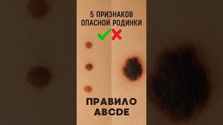 КАК ВЫЯВИТЬ МЕЛАНОМУ ВОВРЕМЯ? #онколог #онкология #рак #опухоль