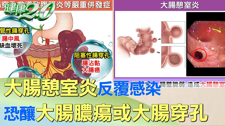 大肠憩室炎反复感染 恐酿大肠脓疡或大肠穿孔 健康2.0 - 天天要闻