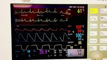 The Arterial Line (A-Line) and Why A Patient May Need One For Surgery