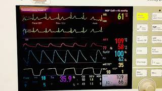 The Arterial Line A-Line And Why A Patient May Need One For Surgery