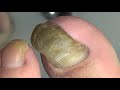 Extremely thick nail