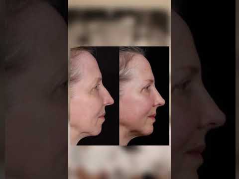 Video thumbnail: Rhinoplasty for Older Folk with Sam & Meg — David A. Hidalgo, MD