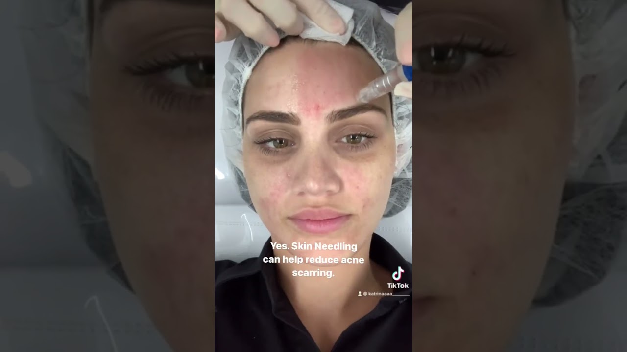 Is Skin Needling good for your skin? | Results Laser Clinic
