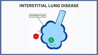 Interstitial Lung Disease Explained