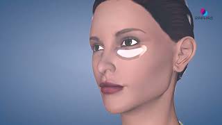 Dissolving Microneedle Patch and How it Works