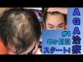 AGA治療スタート！プロペシアとミノキシジルを使っていきます！