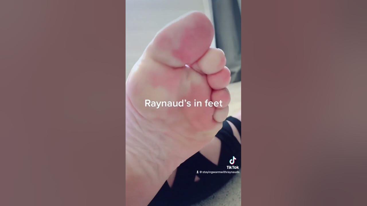 Raynaud’s in Feet - YouTube