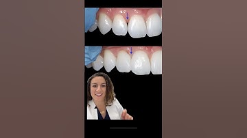 Cosmetic Dentistry: Bioclear Black Triangle Closure