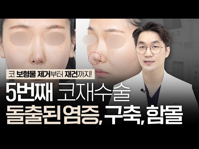 5번째 코재수술｜코끝에 튀어나온 뾰루지? 염증?｜코 보형물 제거부터 코끝 함몰, 구축코 재건까지 회복과정!