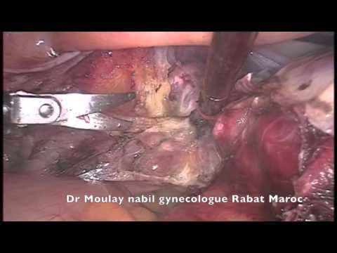 Video: Hysterectomie: Doel, Procedure En Risico's