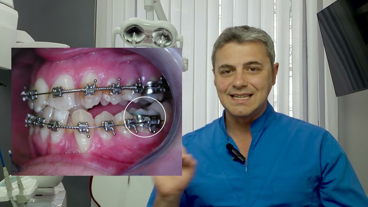 Apparecchio fisso: caso difficile, ma grande soddisfazione (Ep. 10)