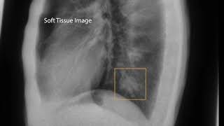 Reveal Clinical Case 2: Discover hidden masses in a lateral chest X ray screenshot 5
