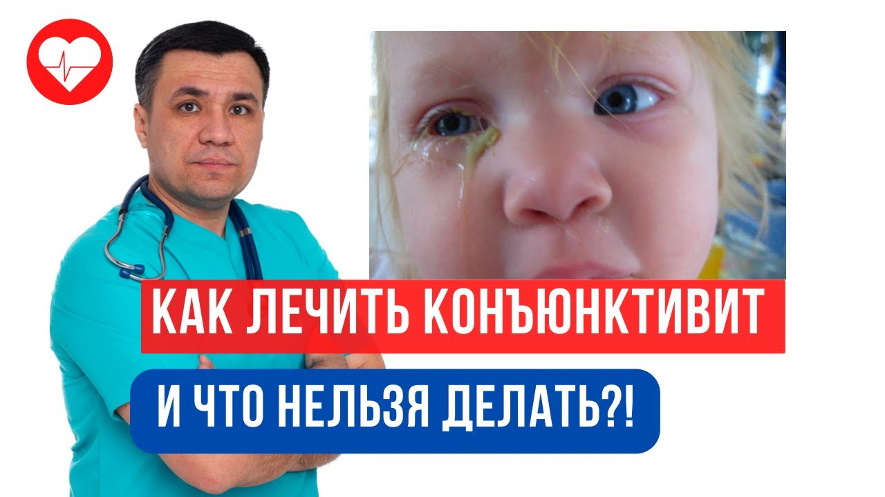 Как лечить конъюнктевит у детей и взрослых?