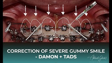 [LECTURE: 9] Damon System and TADS for Correction of Severe Gummy Smile | Orthodontic Biomechanics