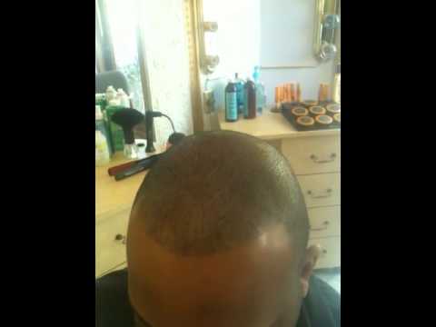 Video thumbnail: Hair Micro Pigmentation | SMP Tattoo | Interview- Client Hairline Hair Simulation#10