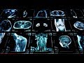 Augmenting Radiology with AI