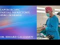 Laparoscopic partial nefrectomy, (zero ischemia) / Лапароскопическая резекция почки