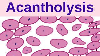 What is Acantholysis? - Pathology mini tutorials