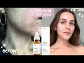 The Ordinary skincare CLEARED MY FACE for good! ACNE OUT (skincare update)