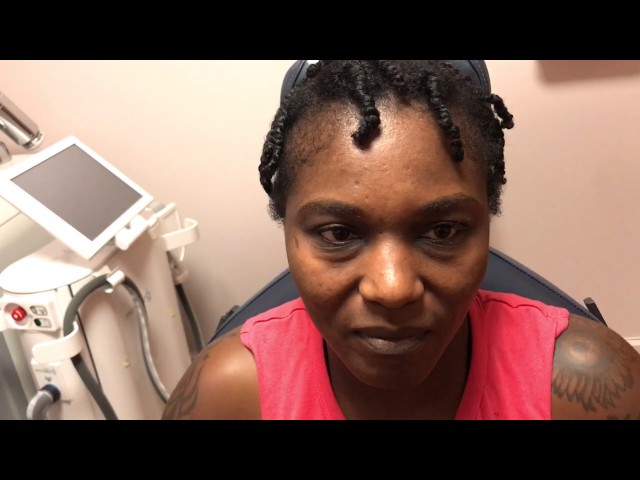 15 Days After Hair Transplant for Traction Alopecia for this African-American Woman