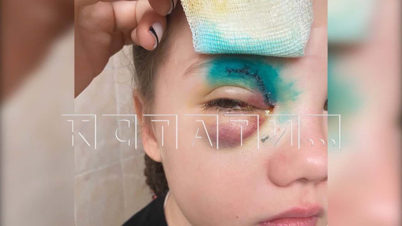 Опасная для детей вешалка искалечила школьницу и едва не лишила её зрения