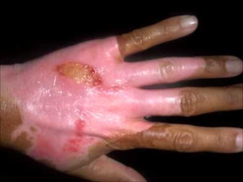 Pomada cicatrizante para queimadura de 2 grau