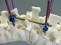 DepuySynthes: USS Fractures