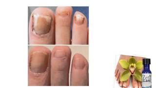 nagelpilz entstehung screenshot 4