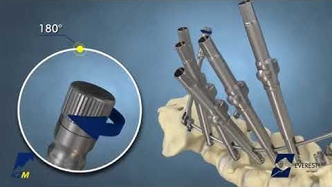 Stryker (K2M): EVEREST Deformity Spinal System Product Animation