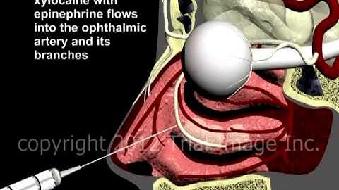 Retinal Injury Ischemic video - Animation by Cal Shipley, M.D.