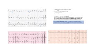 ECG QRS abnormalities- Part 2