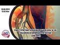 Посттромботическая болезнь и ее эндоваскулярное лечение (обзор)