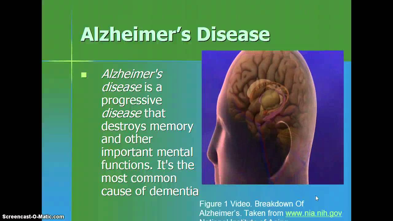 alzheimer's disease presentation