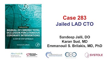 Case 283: Manual of CTO PCI - Jailed LAD CTO