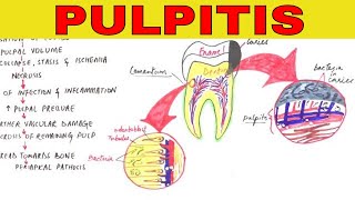 Pulpitis - Pathophysiology, Causes & Types