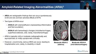 A New Standard of Alzheimer's Care: The New Era of Amyloid-Targeting Therapies