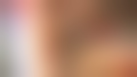 Ruptured L Acom complex aneurysm