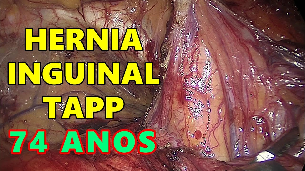 Hernia Inguinal Direita Por Laparoscopia Comentada Fullhd Gopro