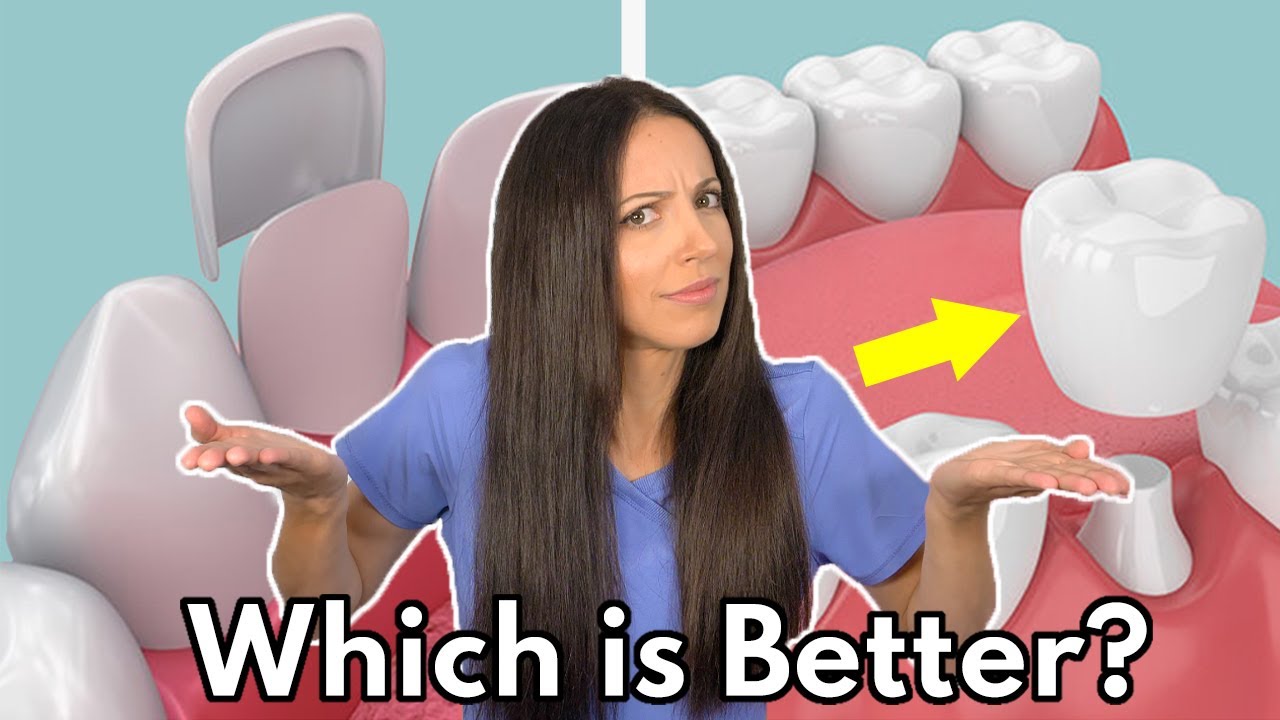 Outline Video Dental Veneers vs. Crowns | Which is Better & What's the Difference