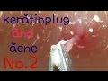 角栓抜き&ニキビ押しNo.2~I pull out keratinplug and acne No.2