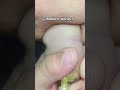 How to insert cannula in new born baby #medicoworld #medicoworld #doctor #healthcare #medicine