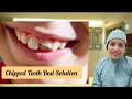 Chipped Tooth Repair l Chipped Teeth Treatment l Chipped tooth filling