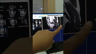 Pemeriksaan Mri Genu
